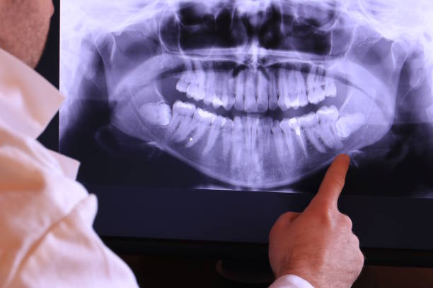Best Emergency Wisdom Teeth Removal in Boise City, OK